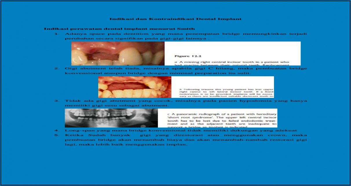 Ada Dental Implant Brochure