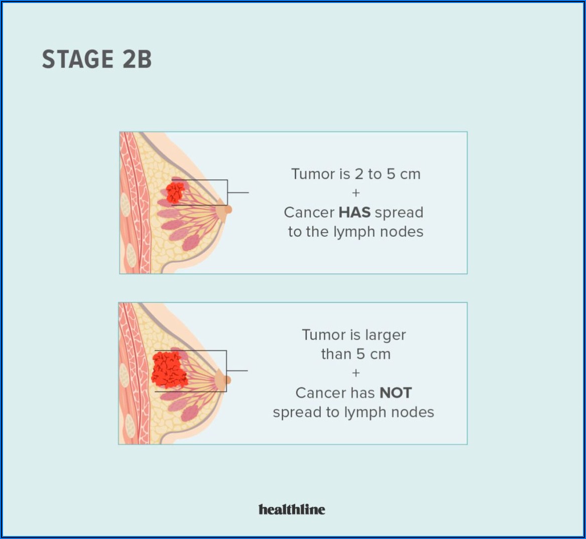 Stage 2 Breast Cancer Treatment Plan