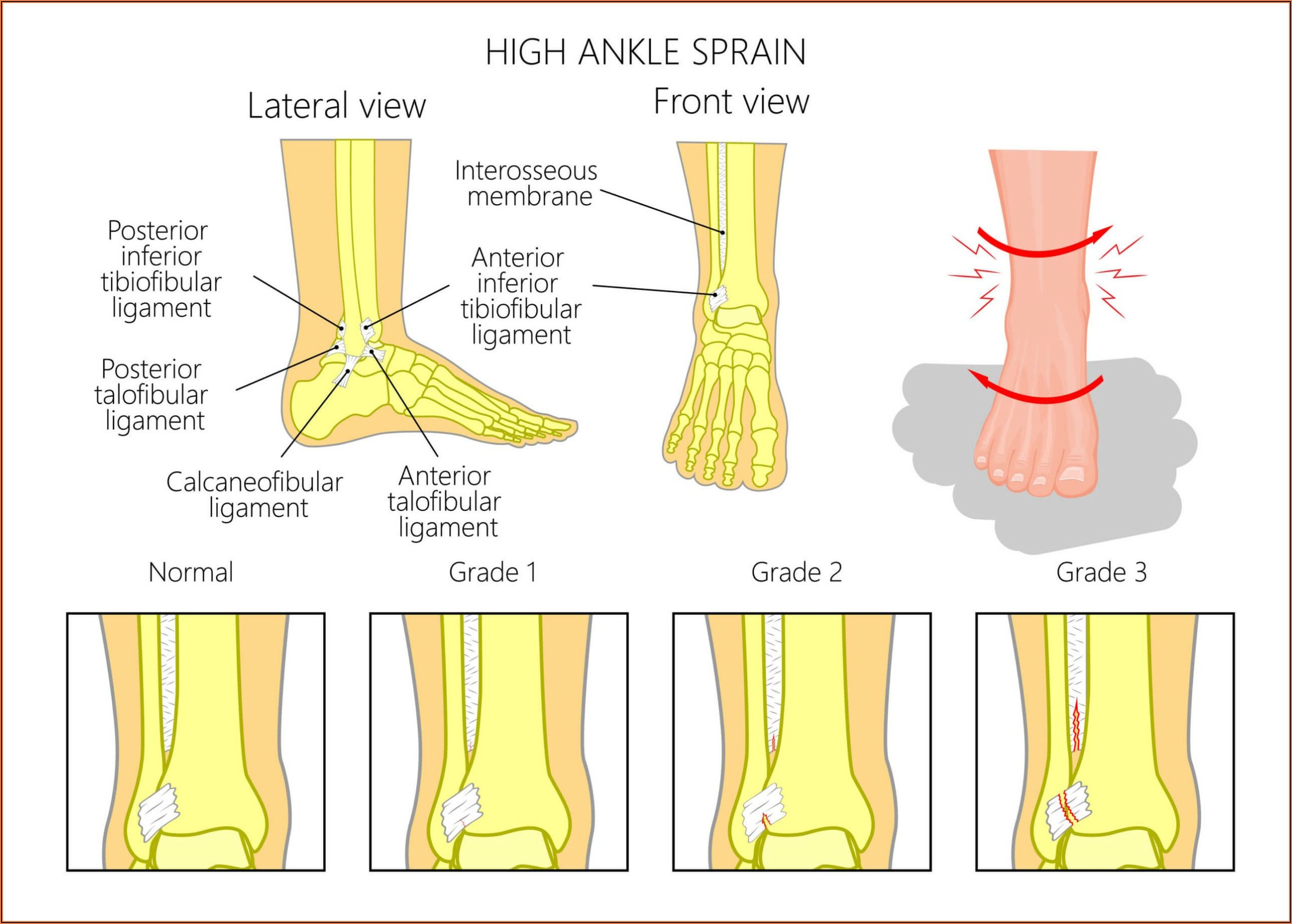 Grade 2 High Ankle Sprain Recovery Time